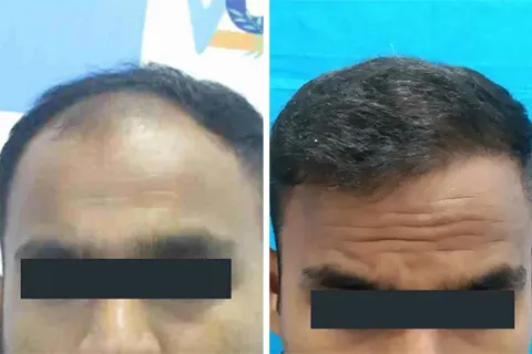 Hair rejuvation therapy before photo in VCare